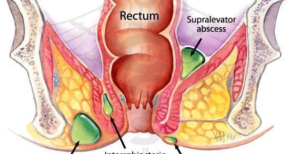 Ci-Ci D. reccomend Anal infection antibiotics